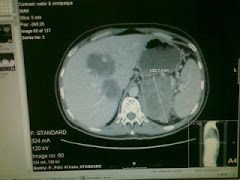 CT scan post cycle 2