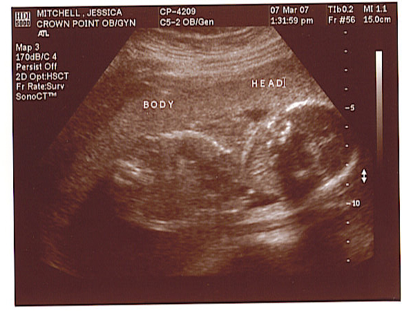 [baby+ultrasound+20+weeks.jpg]