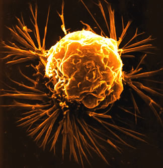 [breast+cancer+cell.jpg]