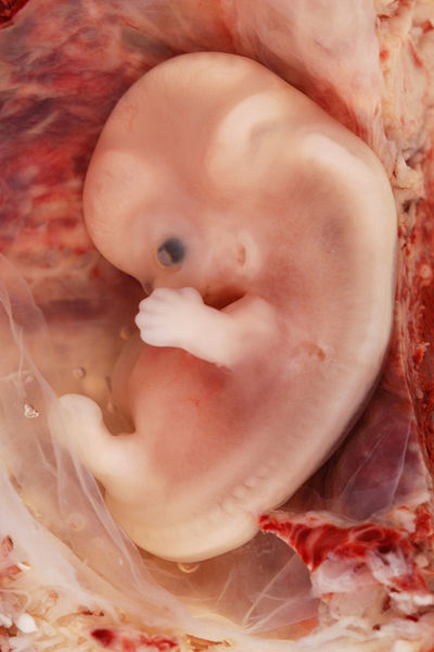 [400px-9-Week_Human_Embryo_from_Ectopic_Pregnancy.jpg]