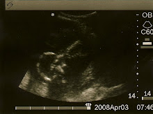 Baby Girl - 17 Weeks