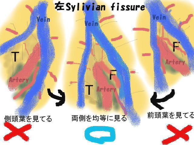 [Sylvian+fissure01.jpg]