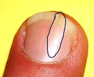 fingernail splits down the middle